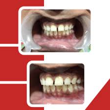 Dental bonding is recommended for people with a small gap that is less than 5mm. How To Fix Gap In Front Teeth Without Braces Jussmile Dental Clinic Chennai