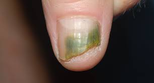 nail fungus onychomycosis laser