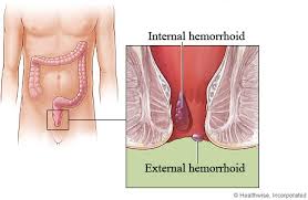 What are thrombosed external hemorrhoids? Hemorrhoids My Doctor Online