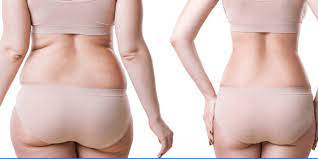 lose weight after gastric sleeve