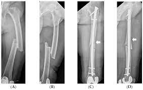 intraoperative iatrogenic fracture