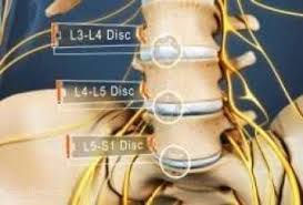 l4 l5 disc bulge slip disc stenosis