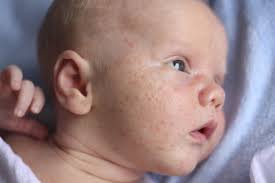 causes and home remes for baby acne