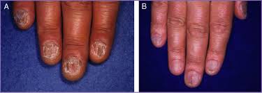 twenty nail dystrophy trachyonychia