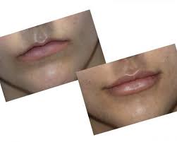 lip filler saluja cosmetic and laser