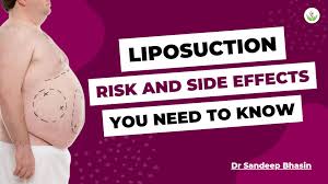 liposuction risk and side effects that