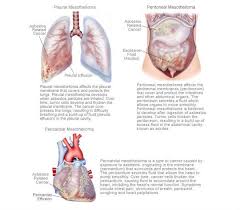 Lung cancer is a serious illness which none of us wish to face. Types Of Mesothelioma Asbestos Diseases Mesothelioma Adviser Mesothelioma Pin Ads Disease