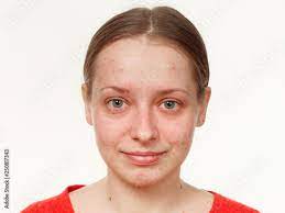 portrait of a without makeup acne