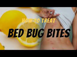 bed bug bite relief effective ways to