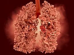 Breathing high levels of asbestos can lead to mesothelioma or lung cancer. What Are The Symptoms Of Asbestos Lung Cancer Pintas Mullins Law Firm