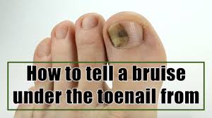 how to tell a bruise under the toenail