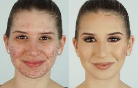 conceal acne with makeup