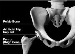 poor results after hip fracture surgery