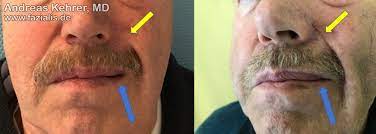 remedy for a weakened mouth ring muscle