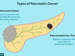 Pancreatic cancer can also make it difficult for the intestines to help break down fats, so stools may become greasy and float in the toilet. Pancreatic Cancer Coping Support And Living Well