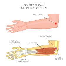 golfers elbow injections what are your