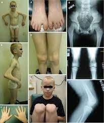 nail patella syndrome cause symptoms
