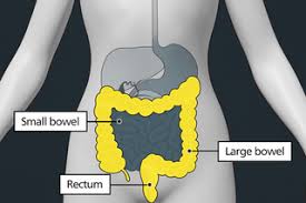 what is bowel cancer nhs