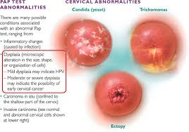 cervical dysplasia and cancer