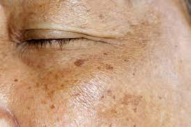 what the brown spots on your skin