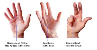 the most common crippling hand disease