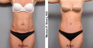 all you need to know about a tummy tuck