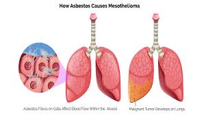 The patient&#x27;s disease, stage of illness, overall health, and age, are all variables that affect this. Asbestos Disease Claims Mooneerams Personal Injury Solicitors