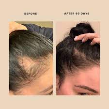 postpartum hair loss how to stop it