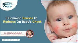9 common causes of redness on baby s cheek