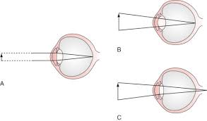 Visual Acuity An Overview Sciencedirect Topics