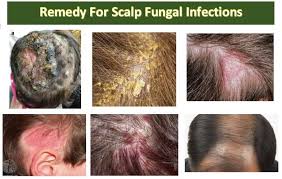 scalp fungal infection fast shoo