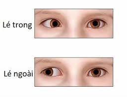Mắt lác ngoài: Cơ chế hoạt động, biểu hiện, cách trị