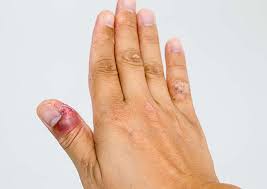 toenail infection fingernail