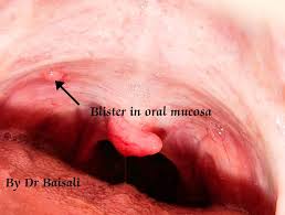 blisters occur in mouth tissues
