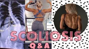 scoliosis q a confidence weight