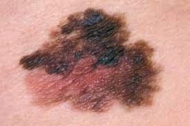 Navigating the choices for skin cancer treatment starts with understanding your options. Melanoma Skin Cancer Nhs