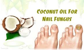 coconut oil for nail fungus treatment