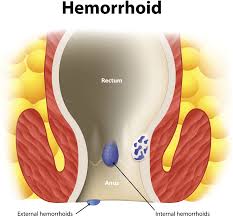 internal hemorrhoids dr zuri murrell