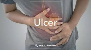 how do you get an ulcer the surprising