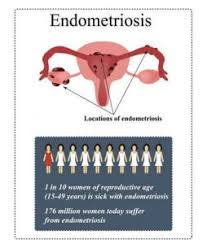 We did not find results for: Endometriosis Astra Laparoscopic Robotic Centre For Women And Fertility