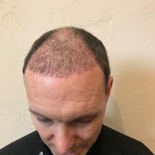 Maybe you would like to learn more about one of these? Stages Of Hair Transplant Growth See This Patient S Hair Grow After A Transplant