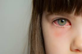 blepharitis vs pink eye know the