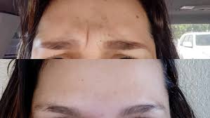 How long does it take for botox to work on forehead. Baby Botox Facts Procedure Risks And What To Expect