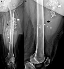 mixed calcification and ossification