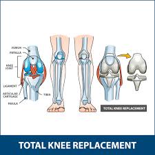 knee replacement surgery florida