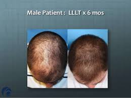 This paper aims to review the existing research studies to determine whether lllt is an effective therapy for aga based on objective measurements and patient satisfaction. Treating Hair Loss W Low Level Laser Therapy Emaa 2012 Paris