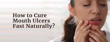 12 natural remes to cure mouth ulcers