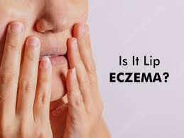 eczema on lips causes symptoms