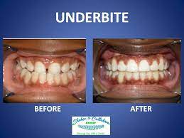 To correct an underbite, you and your dental professional braces : Braces Before And After Underbite Braces Before And After Orthodontics Braces Invisalign Braces