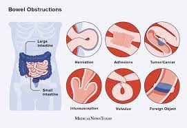 bowel obstruction symptoms causes